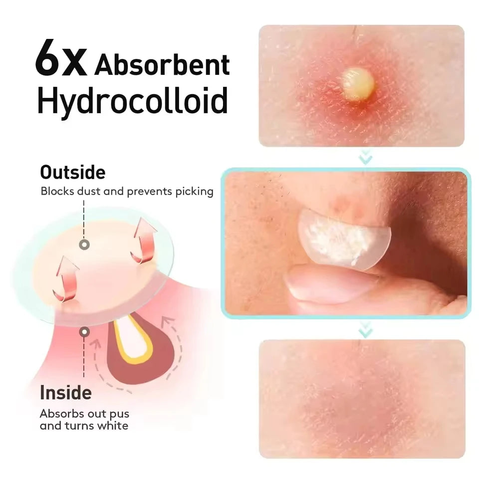 Salicylic Acid Acne Invisible Patches Day & Night 145 Pcs