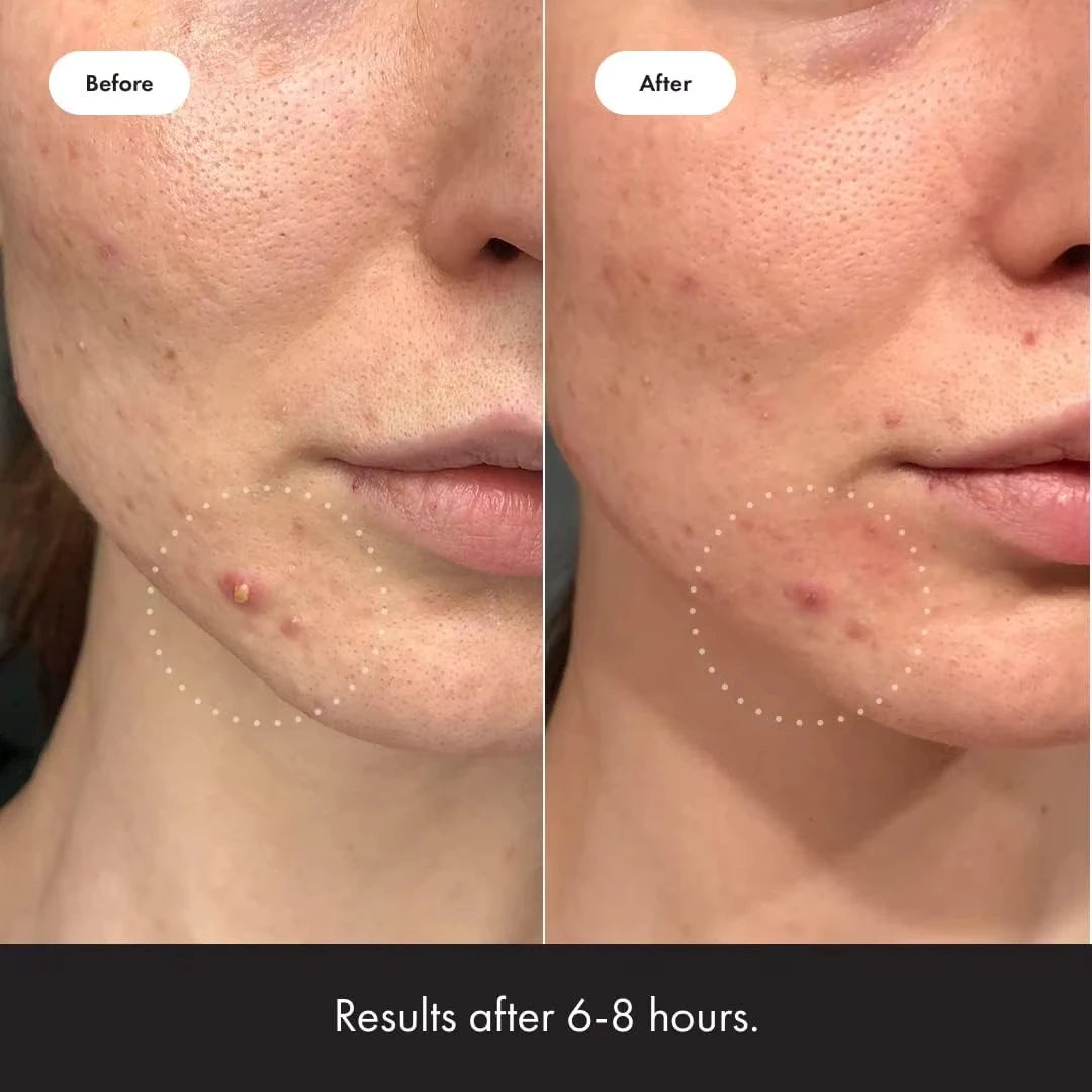 Salicylic Acid Acne Invisible Patches Day & Night – 144 Pack
