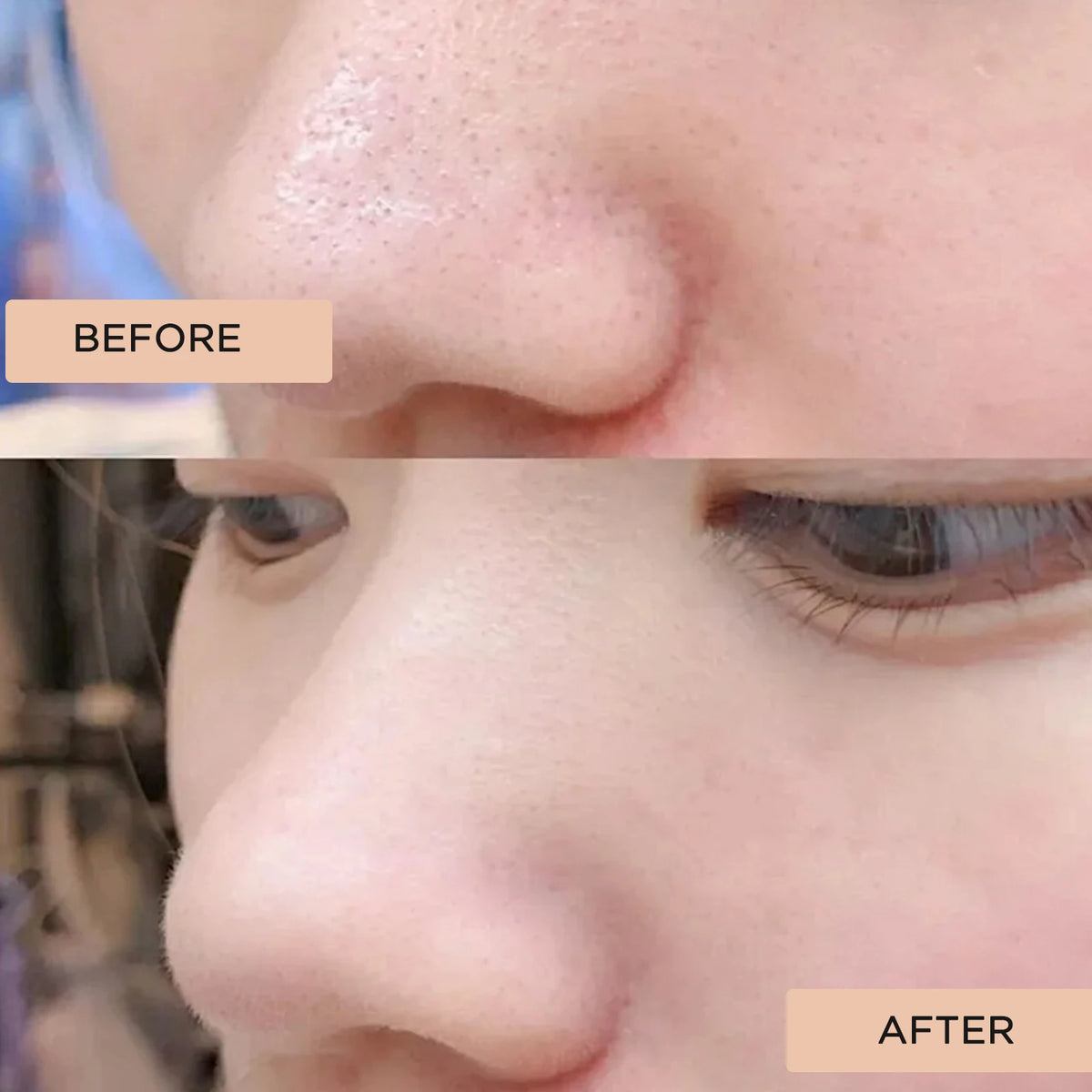 Stainless Steel Blackhead Removal Shovel | Deep Pore Cleanser